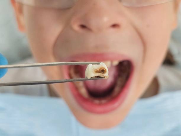 Best Emergency Dental Care for Broken or Chipped Teeth in Hugo, OK